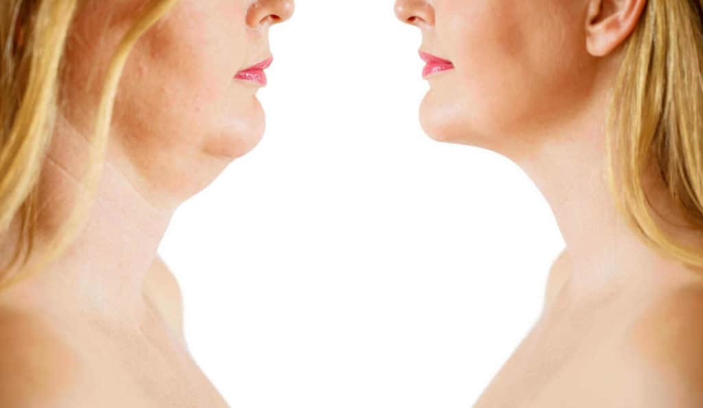 Double Chin treatment Amersham before and after results