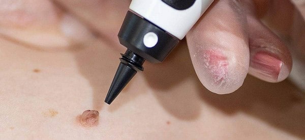 After Skin Tag Removal Amersham