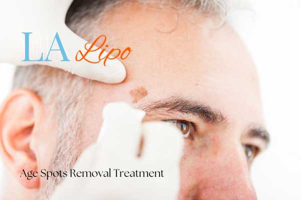 What Are the Most Effective Treatments for Age Spots Amersham?