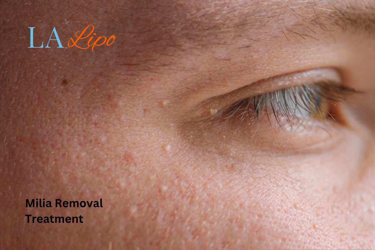 Cryopen Milia Removal: Is It the Easiest and Safest Option Amersham?