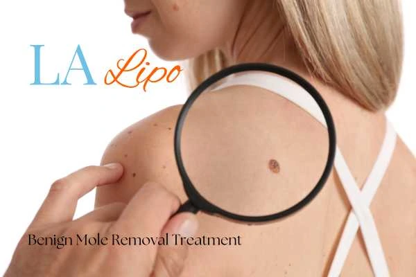 Why getting moles removed Amersham can boost your confidence!