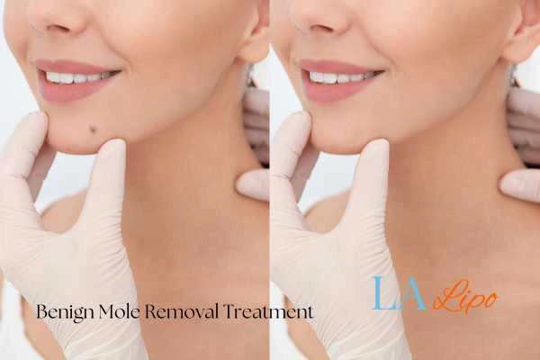 Woman's before and after results of being moles removal treatment Amersham
