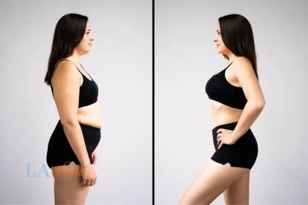 image of woman before and after results of LA-EMS Body Sculpting Amersham to help treat Diastasis recti