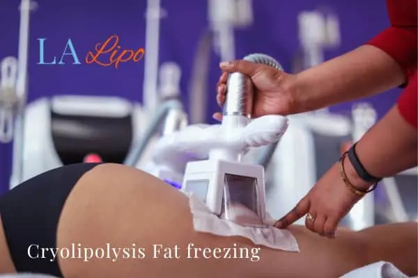women getting fat freezing Amersham