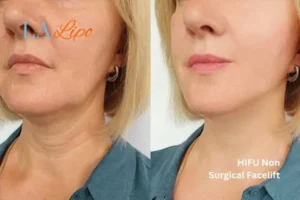 hi-fu for wrinkles Amersham before and after results
