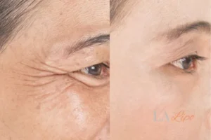Before and after results of woman - HI-fu wrinkles reduction treatment Amersham