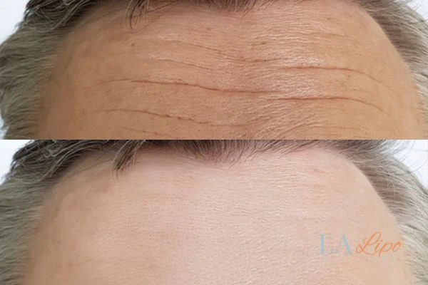 results of HIFU Amersham on mans forehead to help reduce lines and wrinkles