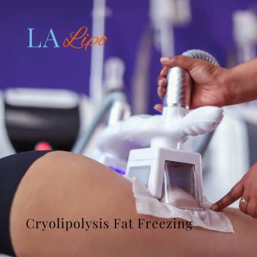 fat freezing - Cryolipolysis Amersham