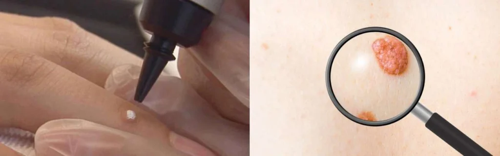 Person getting moles removed with cryopen Amersham