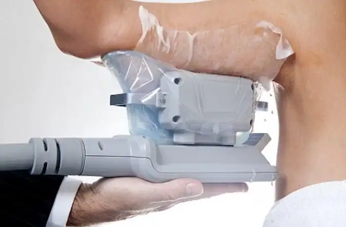 Picture of fat freezing Amersham on the upper arms.