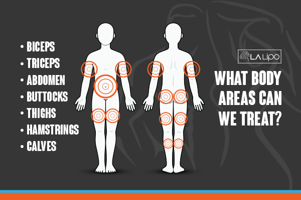 Diagram to show areas you can have LA-EMS Body Sculpting Treatment Amersham