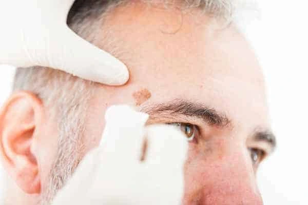 Age spots and elderly people Amersham what is the link?