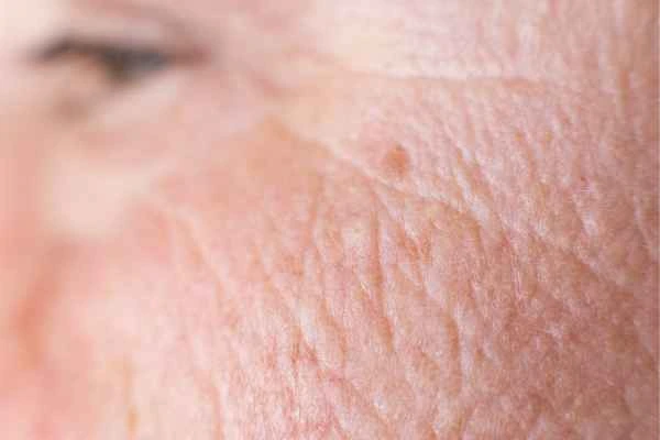 close up picture of a woman's face showing an age spot Amersham
