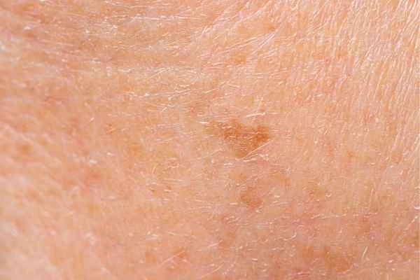 close up picture of age spots Amersham