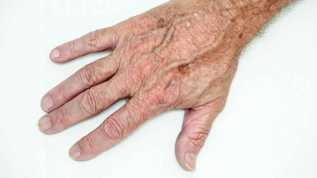 Male hand showing age spot Amersham