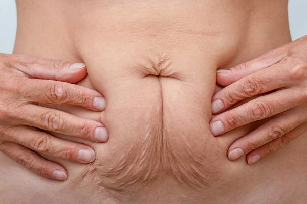 Image of a woman's stomach with loose skin - example of skin tightening Amersham options