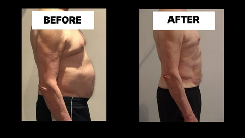 What Symptoms Can Diastasis Recti Cause in Men? Weak Core, Back Pain and Poor Posture Amersham
